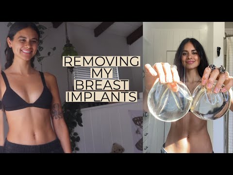 I removed my breast implants (full explant story)