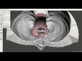 How to Create a Hollow Shell from a Medical STL File Using MeshMixer