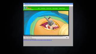 Virtual Hip Resurfacing