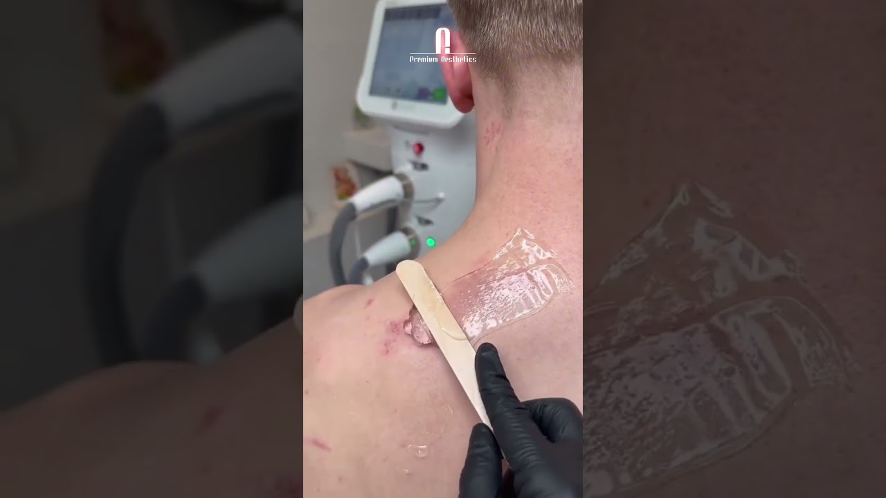 До и после: что делает с кожей аппарат Stellar M22