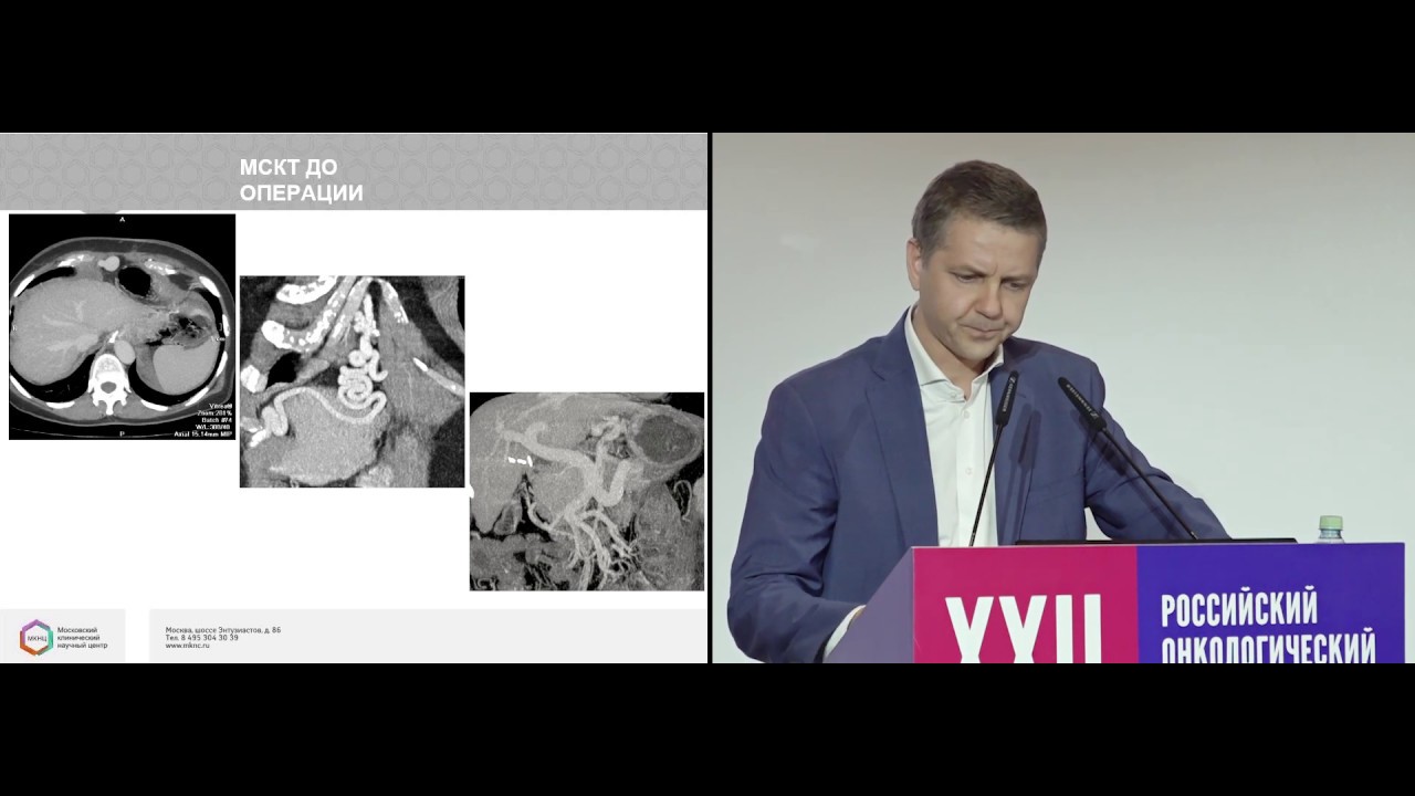 Лапароскопическая дистальная резекция желудка с формированием ...