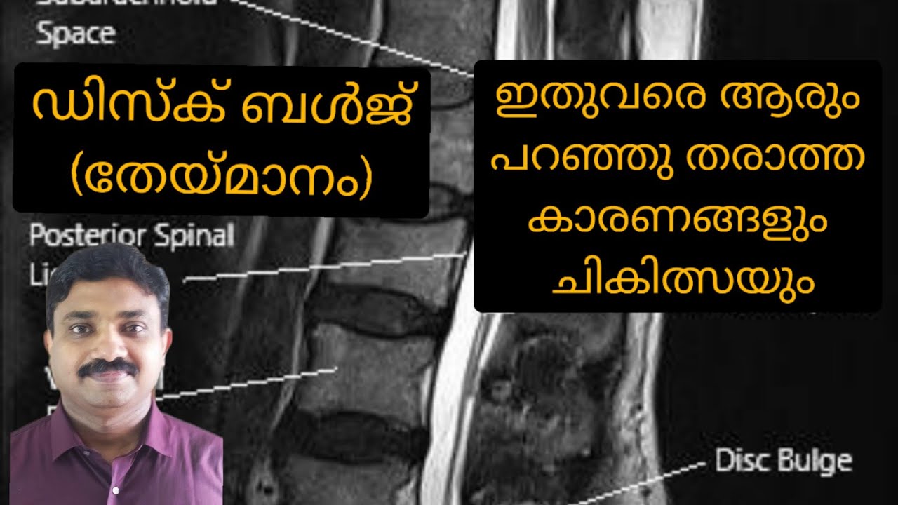 ഡിസ്ക് ബൾജ്( തള്ളൽ, തേയ്മാനം) കാരണങ്ങൾ,ഡിസ്കിലെ ജലാംശം കുറയുന്നത് എന്തുകൊണ്ട്? Disc bulge Ayurveda