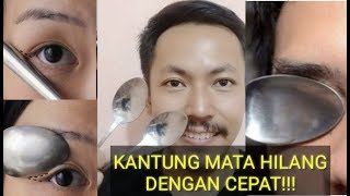 Cara Menghilangkan Kantung Mata Dengan Sendok - Ampuh !