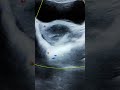 Ovarian cyst Ultrasound ওভারি সিস্ট জরায়ু সিস্ট PCOS infertility USG রিপোর্ট IVF pregnancy আইভিএফ