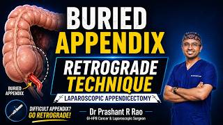 Laparoscopic Retrograde Appendicectomy for Burried Appendix