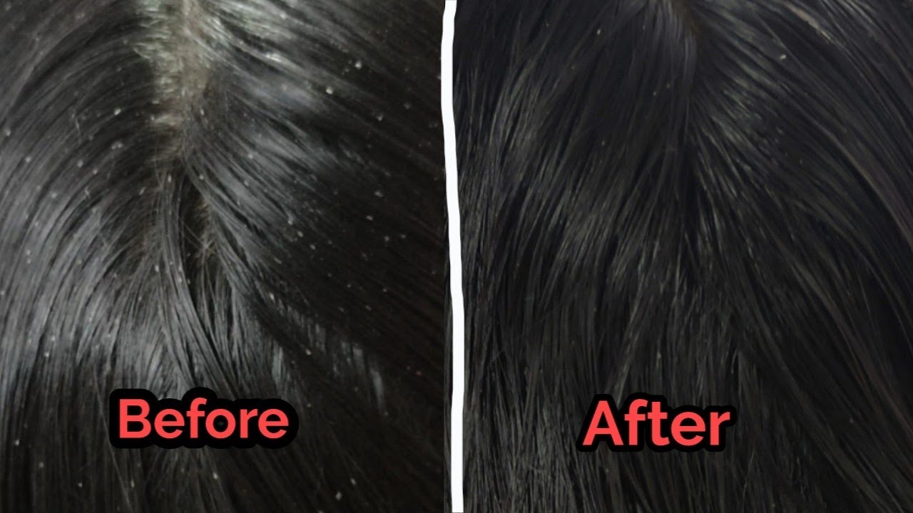 Nits and lice treatment Tamil vinscaretamilnitslicepeneer பேன்