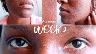 SKIN CARE UPDATE || 2WEEKS /Acne.org Regimen