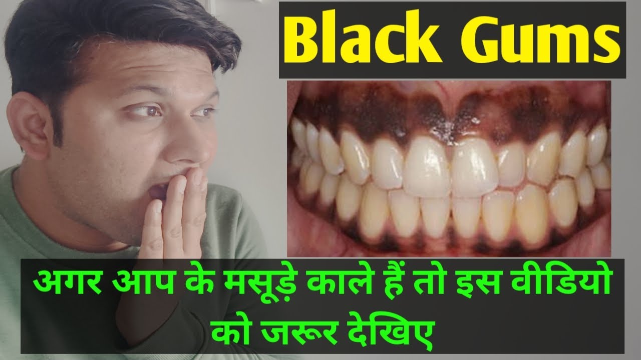Black Gums Reasons and Treatment Options in hindi मसूड़े काले होने