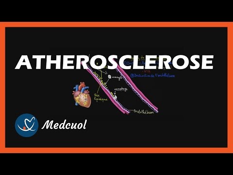 Vidéo: Le Rôle Du Silicium Dans Le Traitement De L'ostéochondrose Et De L'athérosclérose - 1