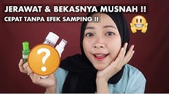 CARA MENGHILANGKAN JERAWAT & BEKASNYA DENGAN CEPAT TANPA EFEK SAMPING  - Durasi: 8.56. 