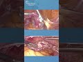 Revealing the Mastery of 3D Laparoscopy: Behind Total Laparoscopic Hysterectomy