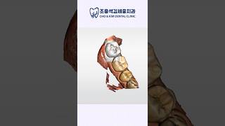 하루만에 완성하는 충치치료_원데이 레진 인레이 #치과치료 #조용석김세웅치과