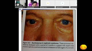 Medicine-Nephrotic Syndrome-(20200429 0621 1)