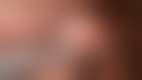 [JMIS] Video of Totally Laparoscopic Modified Esophagogastrostomy Using a Spade Shaped Anastomosis..