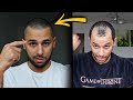 تجربتي الكاملة مع زراعة الشعر داخل العمليات التكلفة بعد مرور سنة 