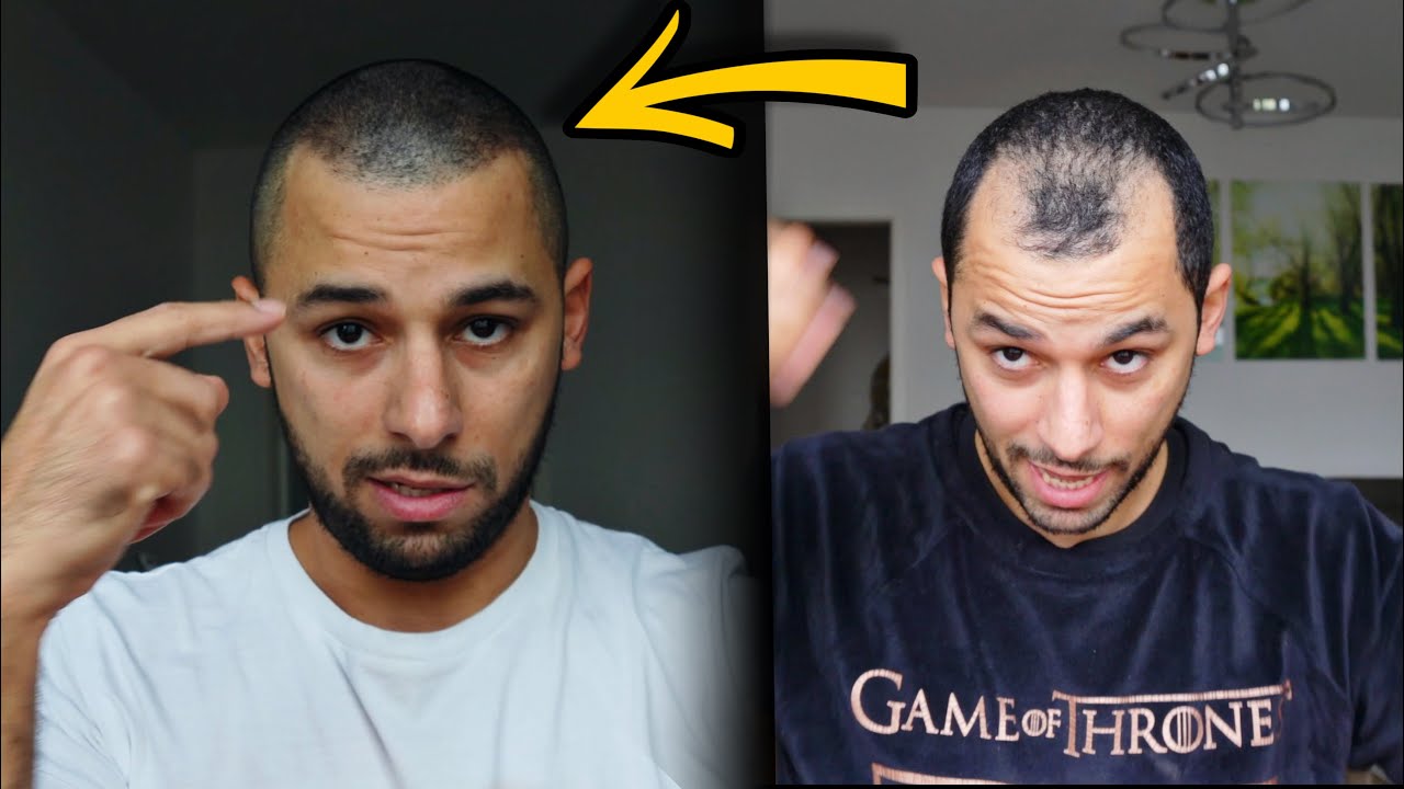 تجربتي الكاملة مع زراعة الشعر | داخل العمليات - التكلفة - بعد مرور سنة