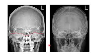 X-RAY POSITIONING OF THE SKULL (2020 UPDATED) screenshot 4