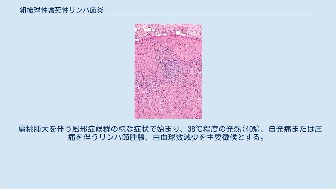 組織球性壊死性リンパ節炎 YouTube