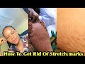 How To: Routine To Get Rid Of Stretch Marks Caused By Cream