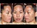 WATCH WHAT HAPPENS AFTER YOU GET A PEEL ( 7 DAY PEEL PROCESS)