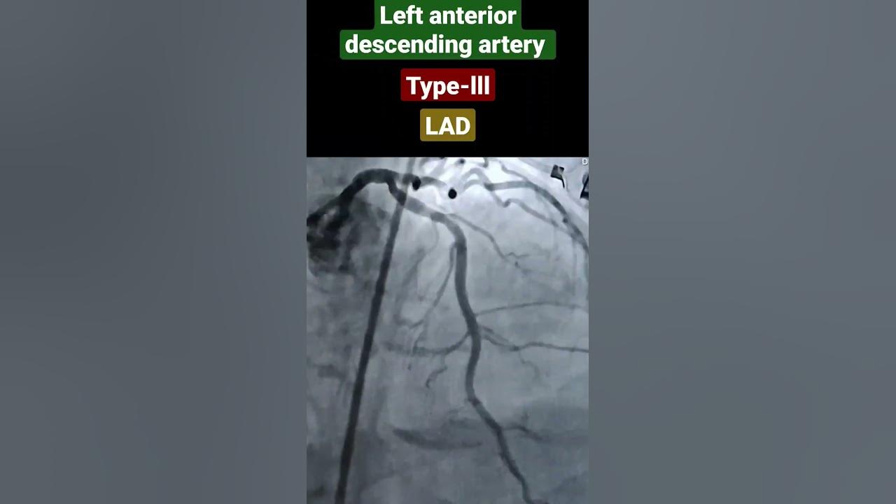 Lad left anterior descending artery type lll angiography widow maker