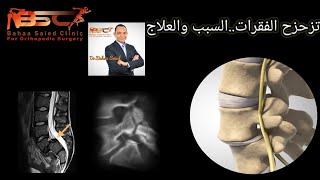 تزحزح الفقرات السبب والعلاج آلام الفقرات