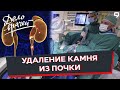 Программа &quot;Дело врачей&quot;. Лазерное дробление камня в почке. Камни в почках.