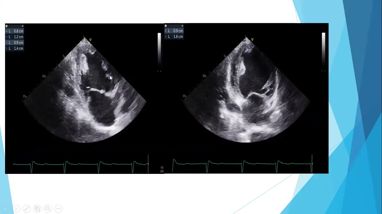 Echo conference 25/2/2026- Dr. Mikhael Mamdouh - dilated cardiomyopathy with LV thrombus