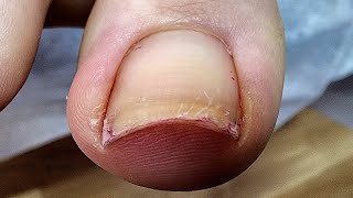 Ingrown toenail. Cleaning and cutting.
