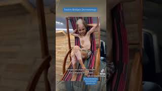 Piebaldism Or Vitiligo?