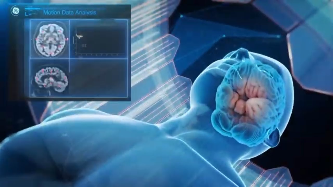 Motion Management for SIGNA PET/MR | GE Healthcare - YouTube