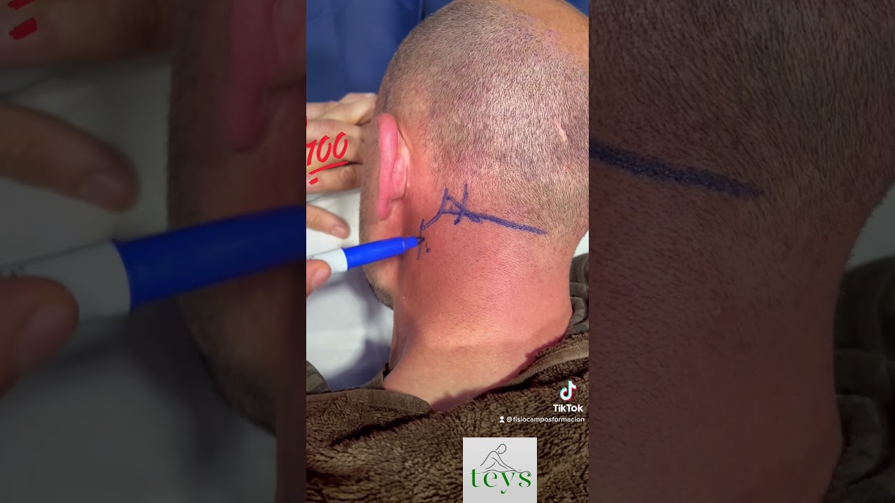 TEYS & Cervicalgia y Acufenos. Inflamación y Dolor Persistente que provocan estos Ruidos de Oído