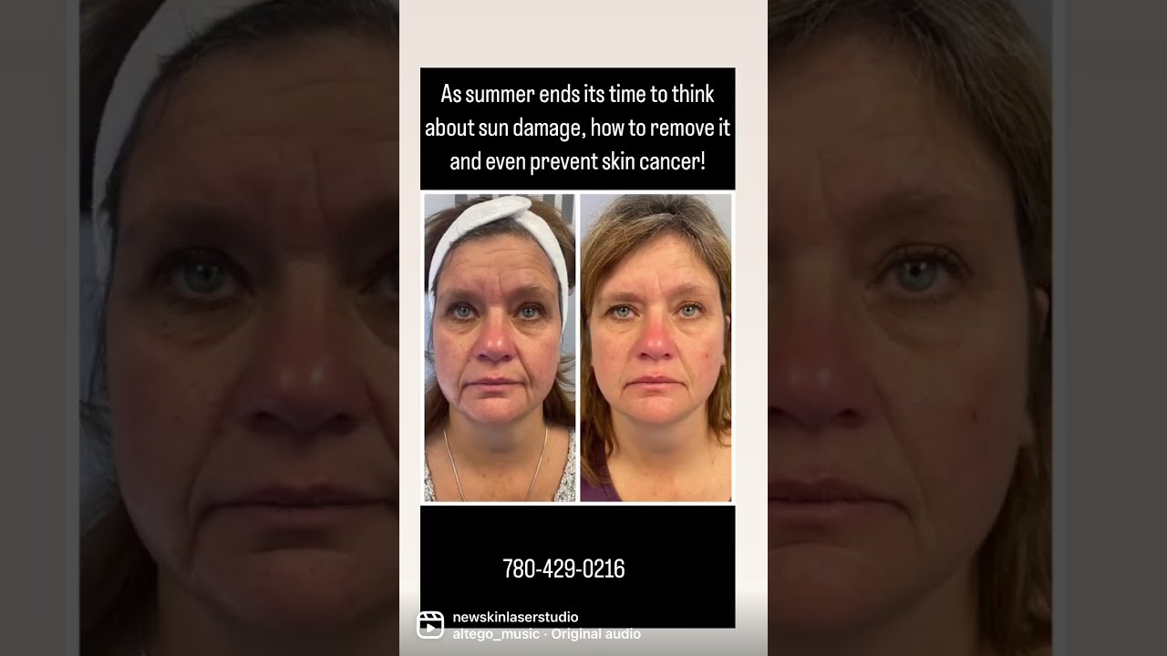 Summer Tans Are Great But What About All That Skin Damage And Blotchy
