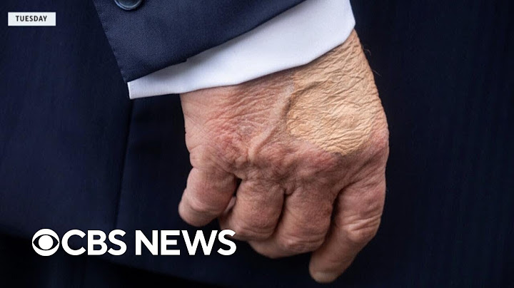 Doctor breaks down Trump's diagnosed vein condition, hand bruising