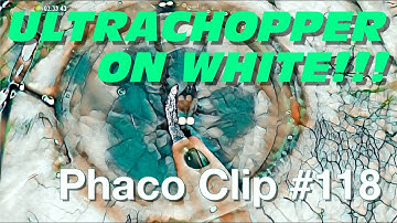 Phaco Clip #118 - Supported Ultrachopping On White