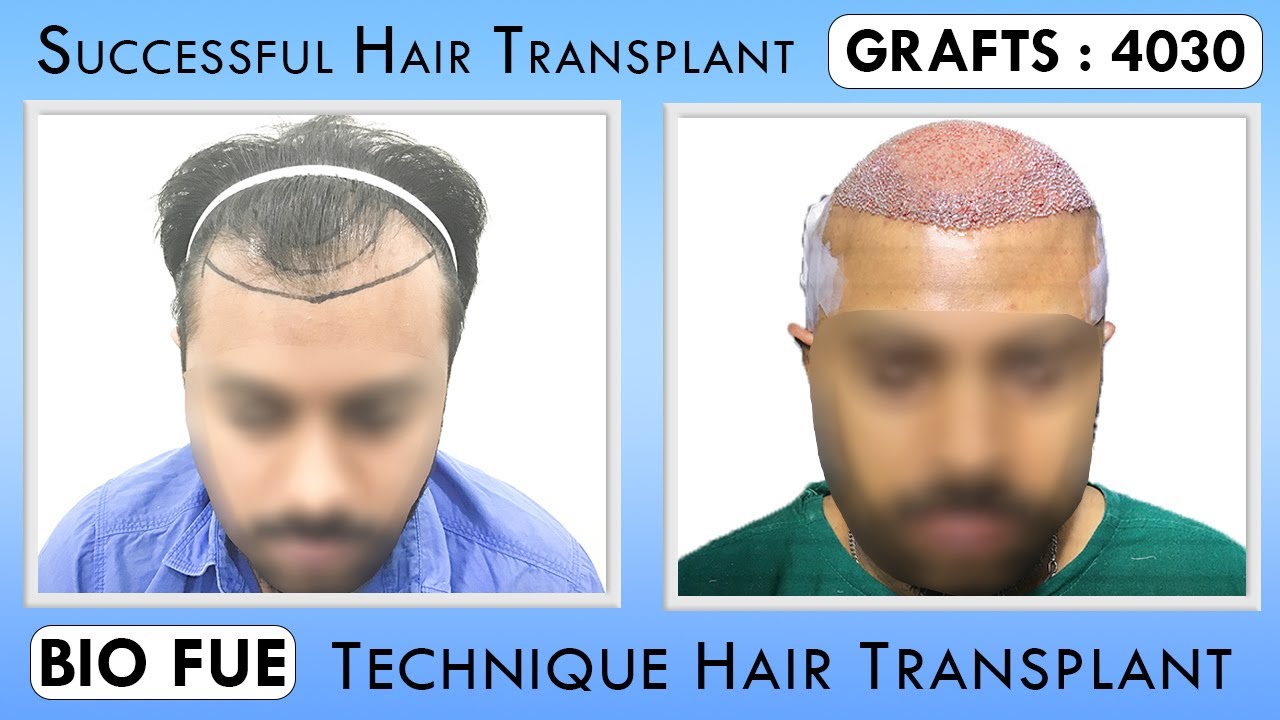 Best Hair Transplant In Kolkata || Hairfree & Hairgrow Clinic ||after hair  transplant Patient Review - YouTube