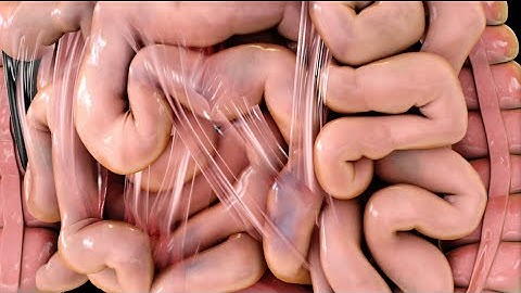 Laparoscopic Lysis of Abdominal Adhesions