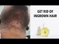 How to get rid of ingrown hairs for good| 2020 Skin Care