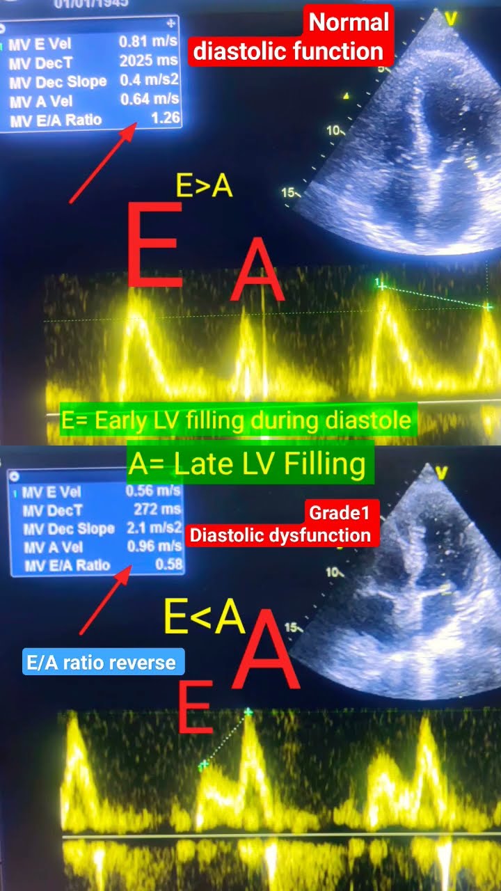 Grade 1 Diastolic Dysfunction In Echo L Grade 1DD L E A Ratio In Echo Grade 1 Diastolic Dysfunction In Echo L Grade 1DD L E A Ratio In Echo