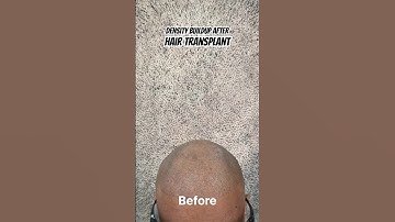 Hair transplant failure, Density buildup with Scalp micropigmentation #scalpmicropigmentationindia