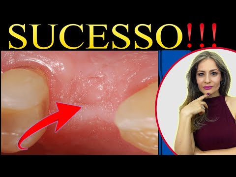 Vídeo: Como se recuperar após uma cirurgia no dente do siso: 14 etapas