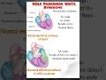 Wolf Parkinson White Syndrome 🩺 #aiims #jipmer #rrb #mrb #esic #all competitive exams 🩺