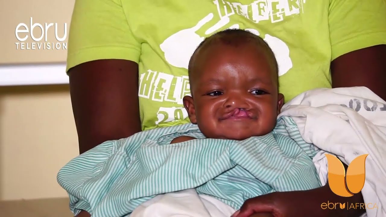 Relief For Children Suffering From Cleft Lips And Cleft Palates In Kisumu