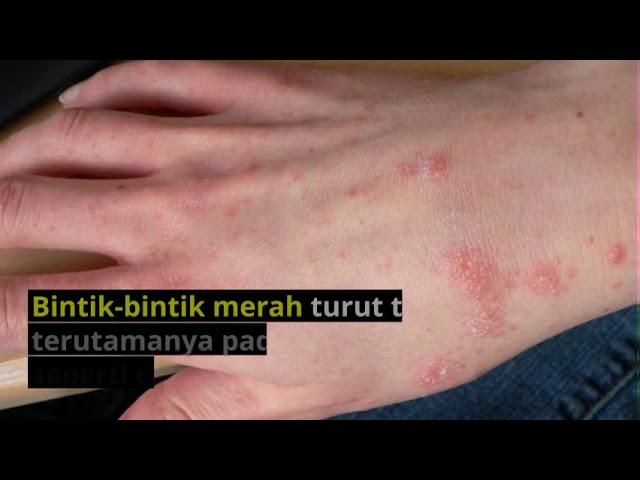Scabies in malay