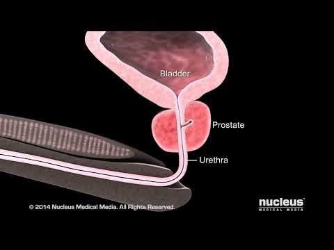 Wideo: Dlaczego prostata się powiększa?