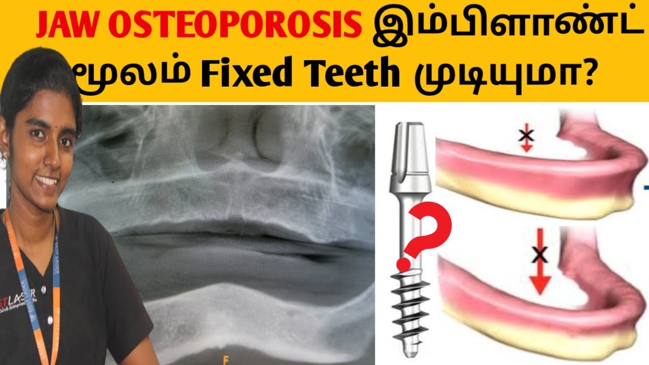 Jaw osteoporosis இம்பிளாண்ட் மூலம் பிக்சட் பல்! Full teeth implants for jaw osteoporosis YouTube