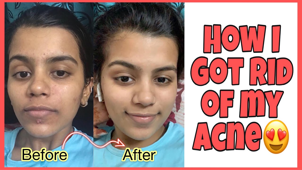 How I got rid of my acne | My acne Journey + Skincare routine | Rutuja ...