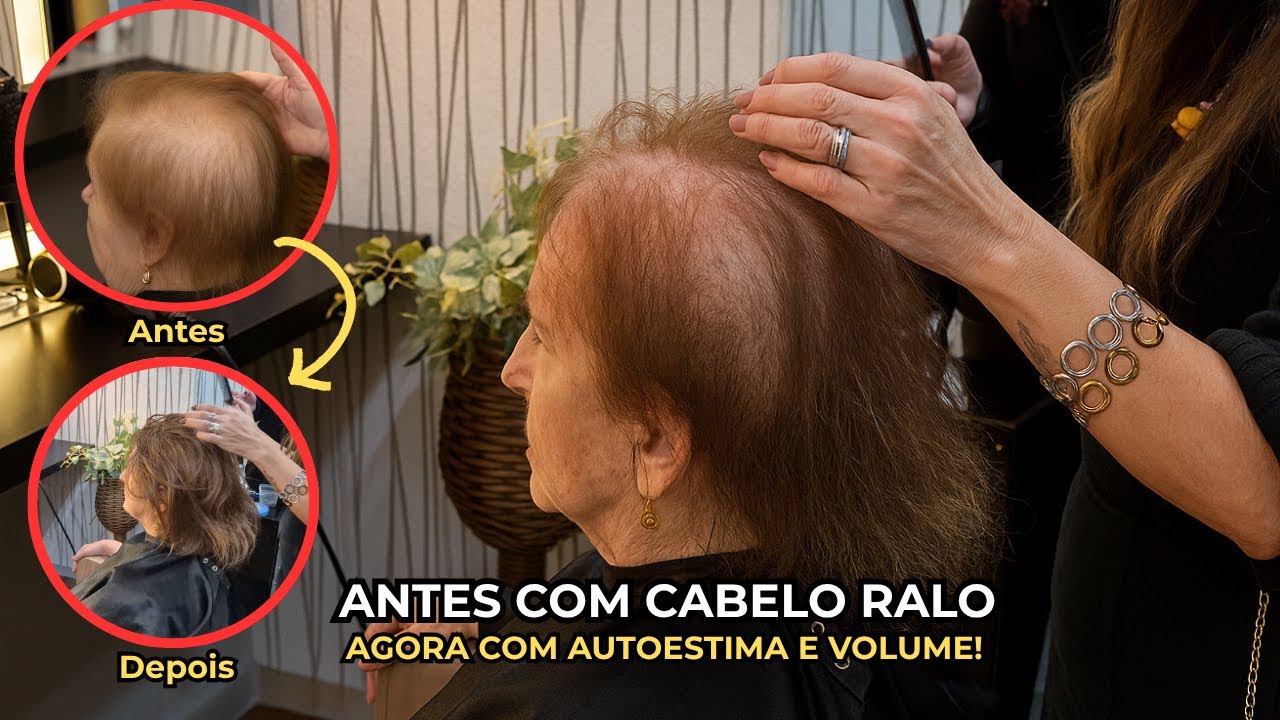 Ela achava que não tinha mais solução… até conhecer a prótese capilar ideal para cabelos ralos!