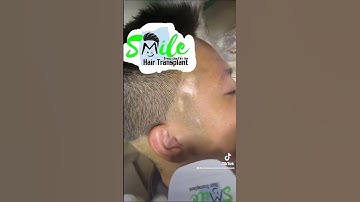 Cấy tóc vùng sẹo sau 6 tháng