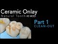 Ceramic Onlay Part 1 (Clean-out)